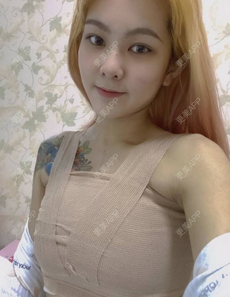 更美 - 珊小姐的自体脂肪隆胸经验 | 自体脂肪隆胸 | 南昌