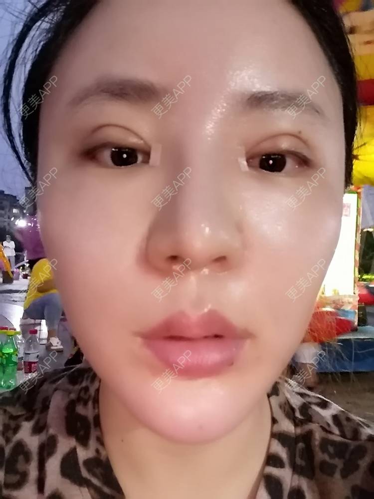 更美 - 静静子子的鼻部多项经验 | 鼻部多项 | 首尔