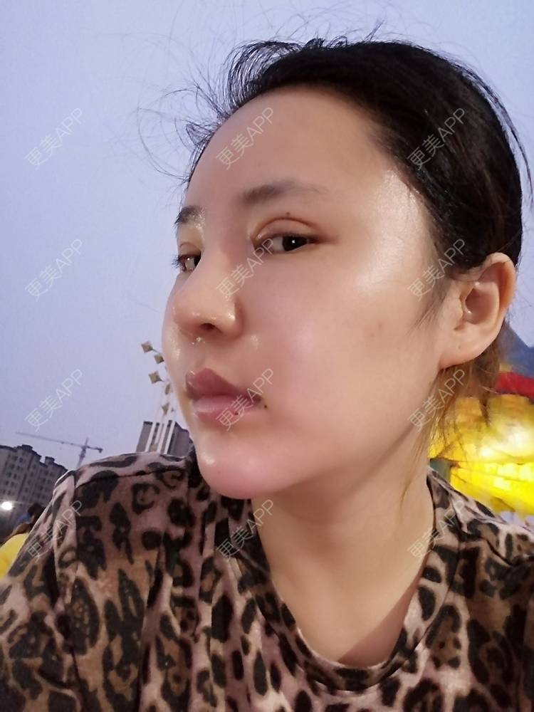 更美 - 静静子子的鼻部多项经验 | 鼻部多项 | 首尔