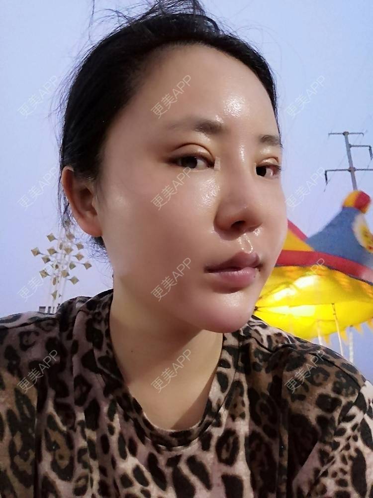 更美 - 静静子子的鼻部多项经验 | 鼻部多项 | 首尔