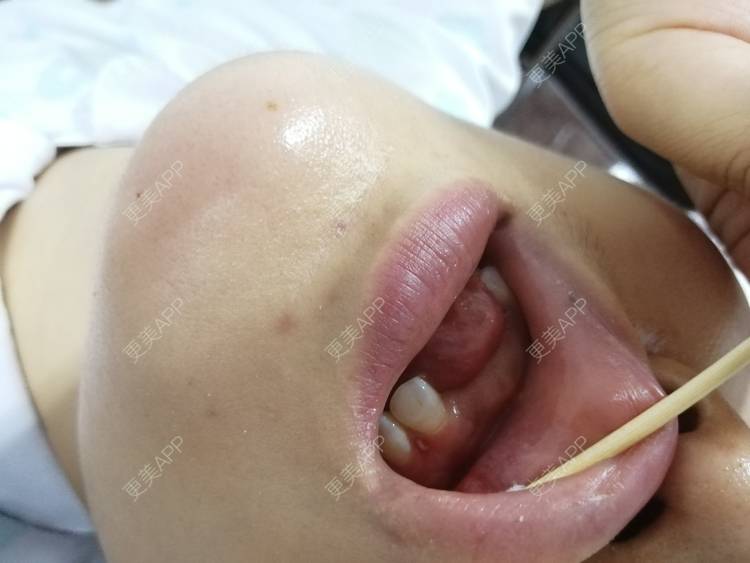 更美 - 静静子子的鼻部多项经验 | 鼻部多项 | 首尔