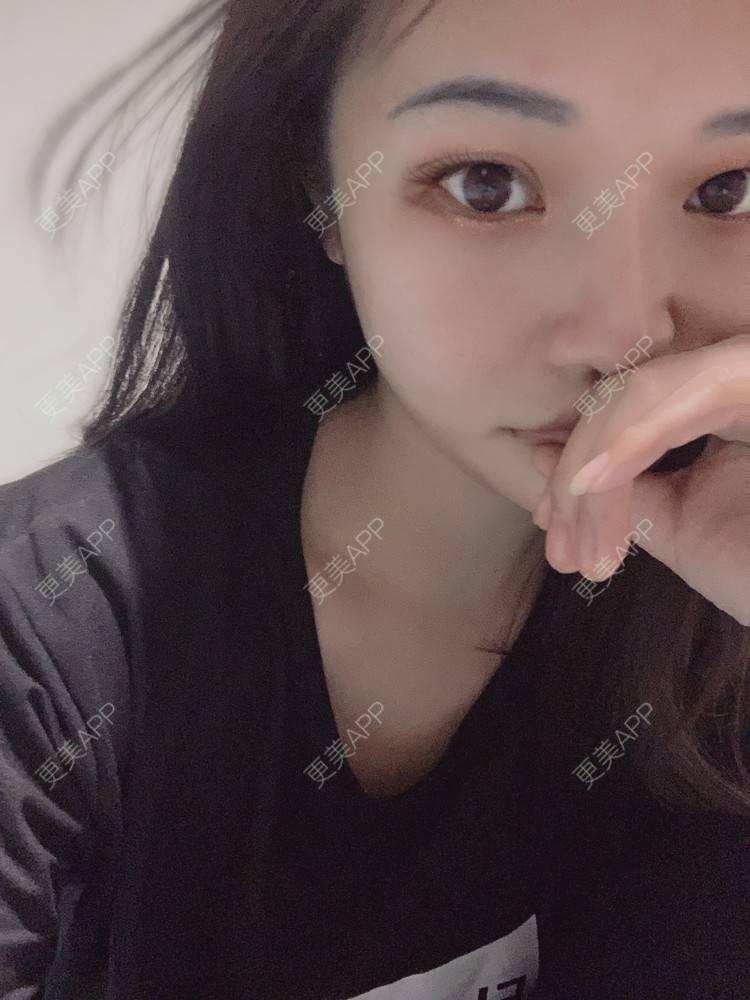 更美 - 虽醉尤醒的激光洗眉经验 | 上海 | 激光洗眉