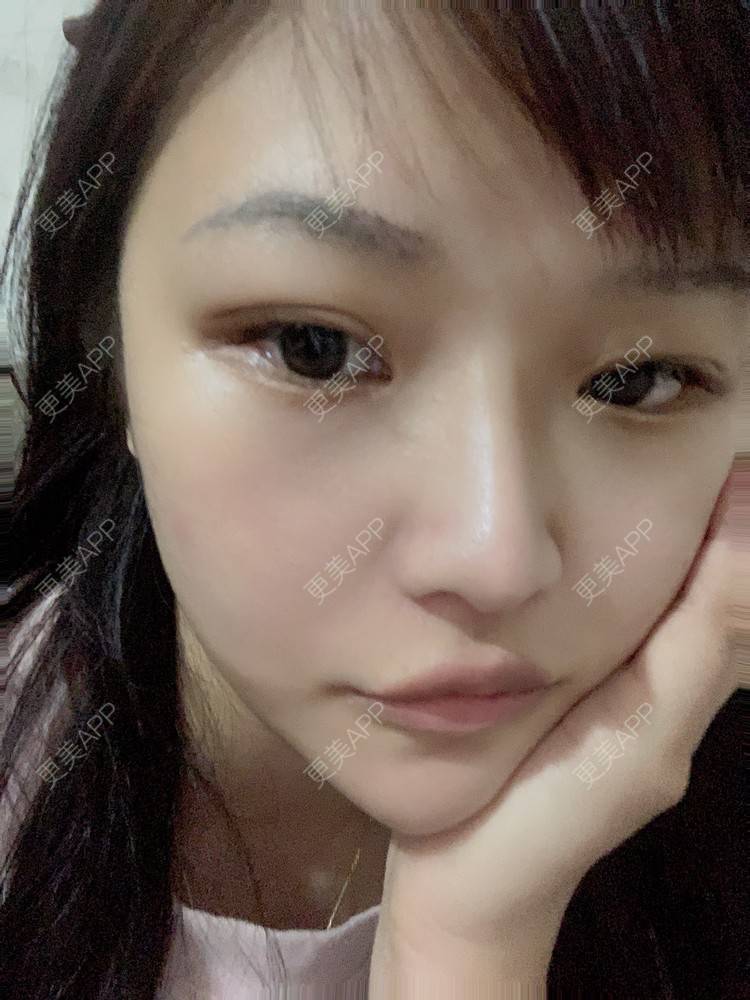 更美 - 虽醉尤醒的激光洗眉经验 | 上海 | 激光洗眉