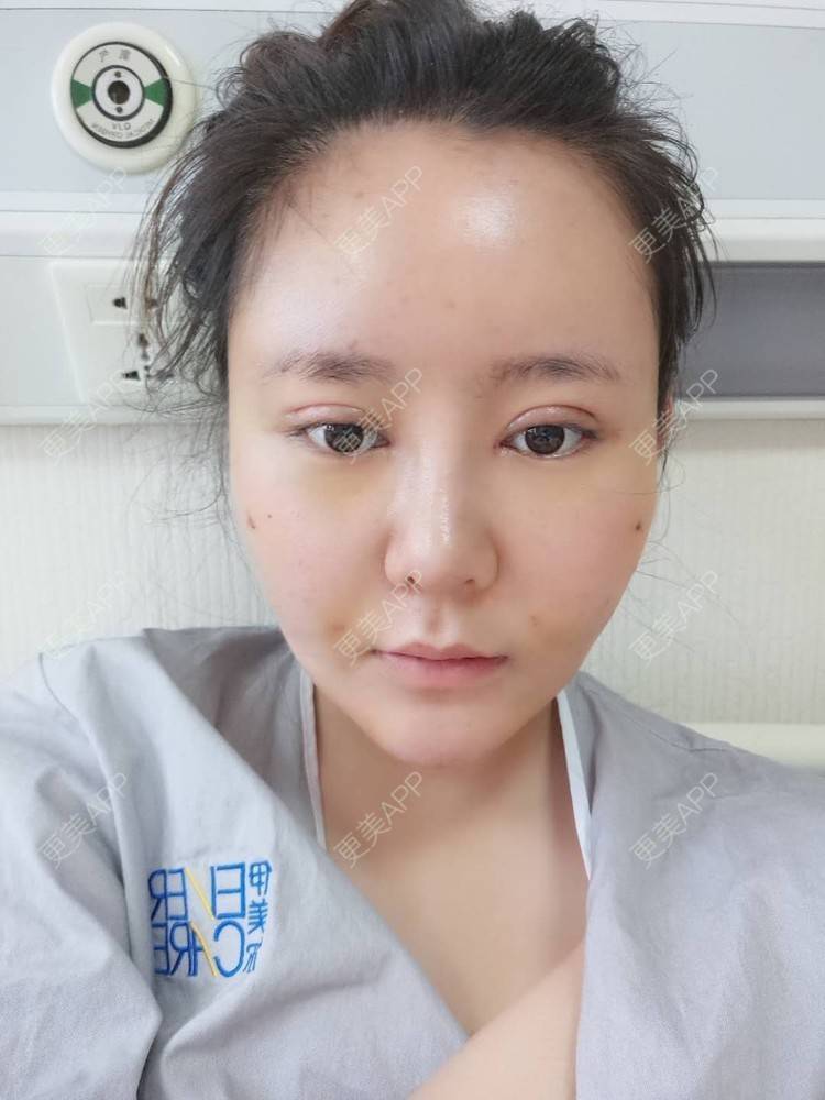 更美 - 更美用户FghWH0HO4e的双眼皮经验 | 双眼皮 | 吸脂瘦脸 | 膨体隆鼻 | 青岛 | 自体脂肪全面部填充 | 眼部多项