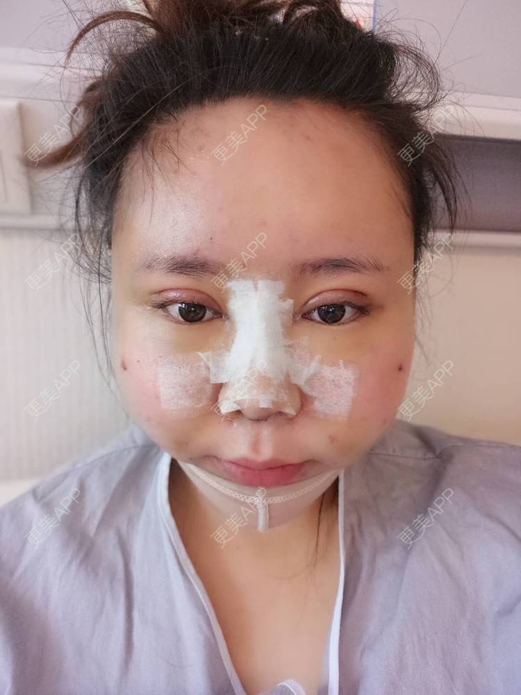 更美 - 更美用户FghWH0HO4e的双眼皮经验 | 双眼皮 | 吸脂瘦脸 | 膨体隆鼻 | 青岛 | 自体脂肪全面部填充 | 眼部多项