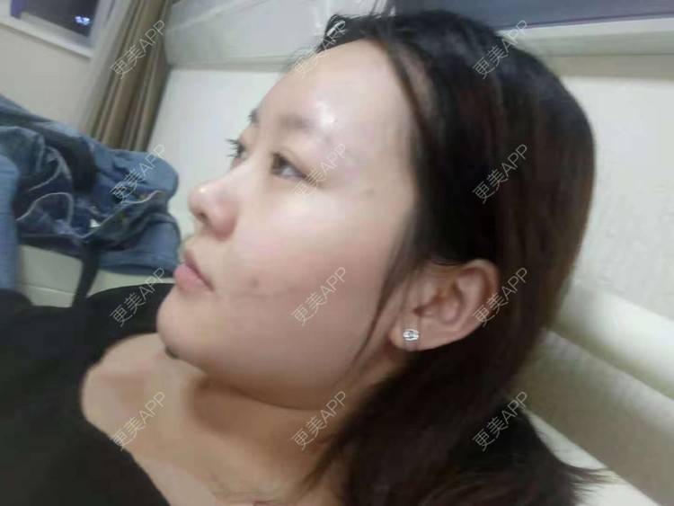 更美 - 更美用户FghWH0HO4e的双眼皮经验 | 双眼皮 | 吸脂瘦脸 | 膨体隆鼻 | 青岛 | 自体脂肪全面部填充 | 眼部多项
