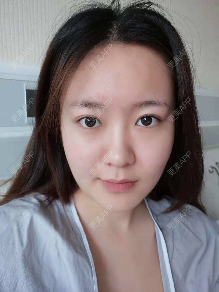 更美 - 更美用户FghWH0HO4e的双眼皮经验 | 双眼皮 | 吸脂瘦脸 | 膨体隆鼻 | 青岛 | 自体脂肪全面部填充 | 眼部多项