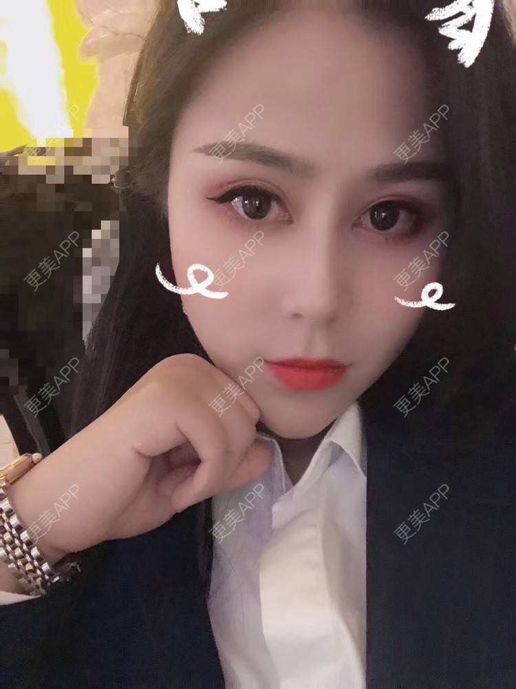 更美 - 更美用户zwQN5e8jIh的鼻部多项经验 | 鼻部多项 | 长沙