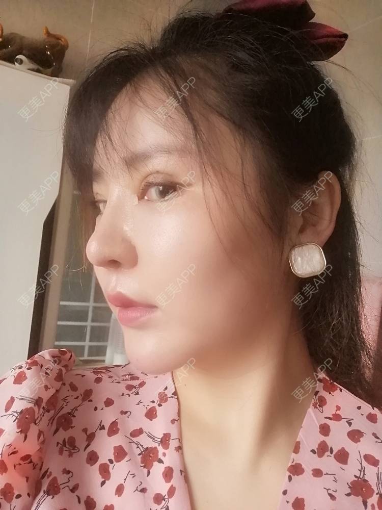 更美 - 静静子子的鼻部多项经验 | 视频日记 | 鼻部多项 | 首尔