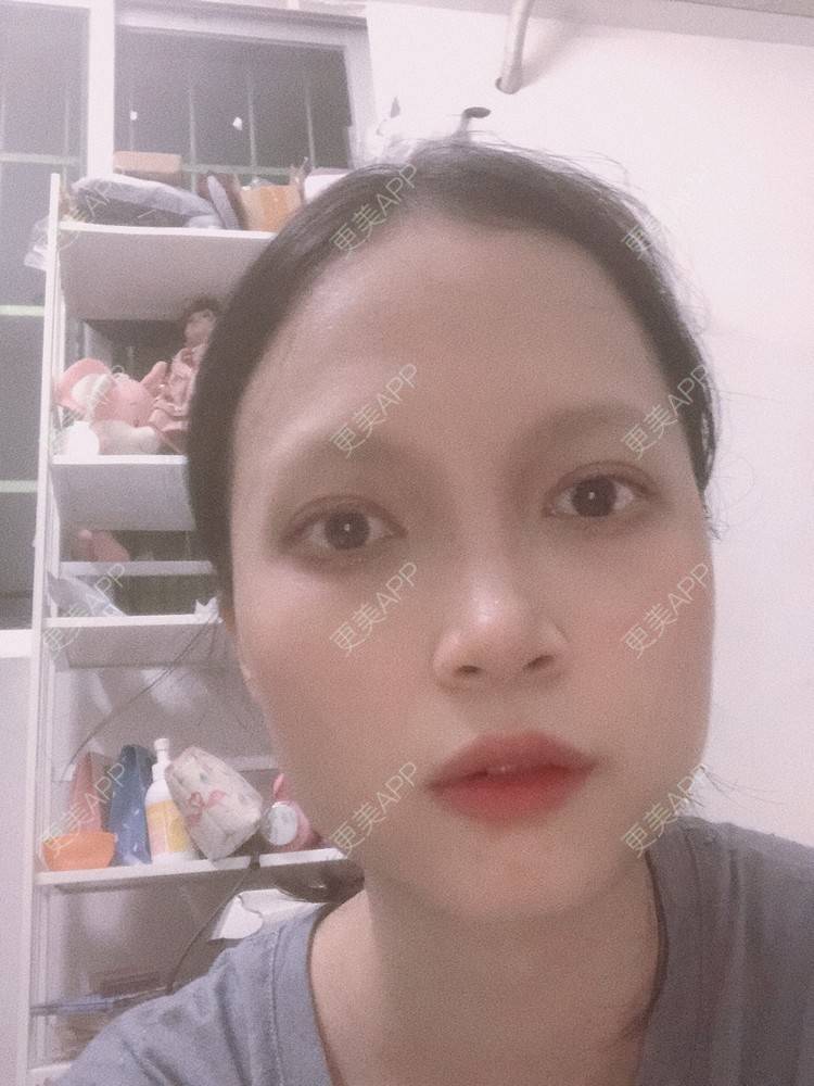 更美 - 更美用户NpS93HK67Y的双眼皮经验 | 双眼皮 | 广州