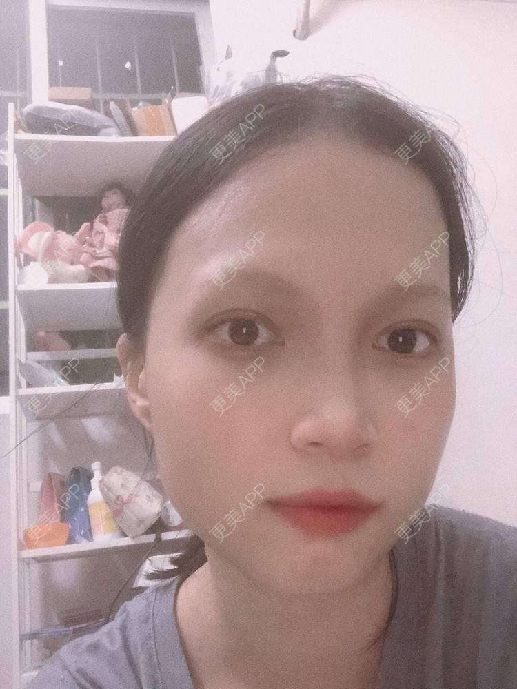 更美 - 更美用户NpS93HK67Y的双眼皮经验 | 双眼皮 | 广州