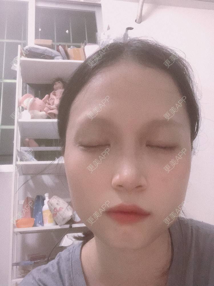 更美 - 更美用户NpS93HK67Y的双眼皮经验 | 双眼皮 | 广州