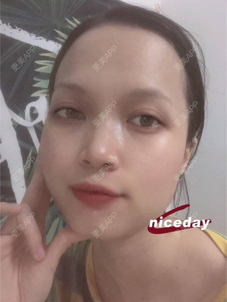 更美 - 更美用户NpS93HK67Y的双眼皮经验 | 双眼皮 | 广州