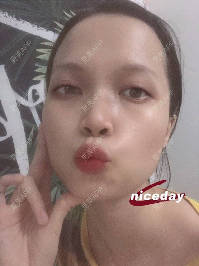 更美 - 更美用户NpS93HK67Y的双眼皮经验 | 双眼皮 | 广州