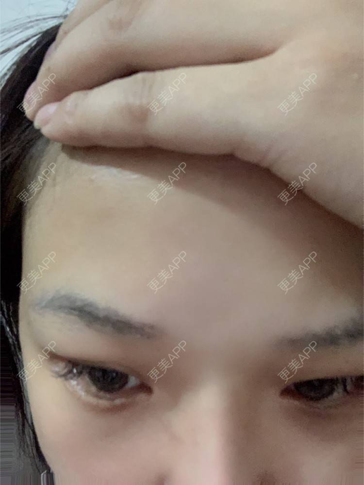 更美 - 虽醉尤醒的激光洗眉经验 | 上海 | 激光洗眉