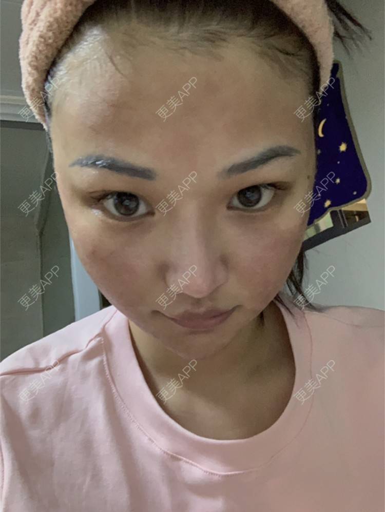 更美 - 虽醉尤醒的激光洗眉经验 | 上海 | 激光洗眉