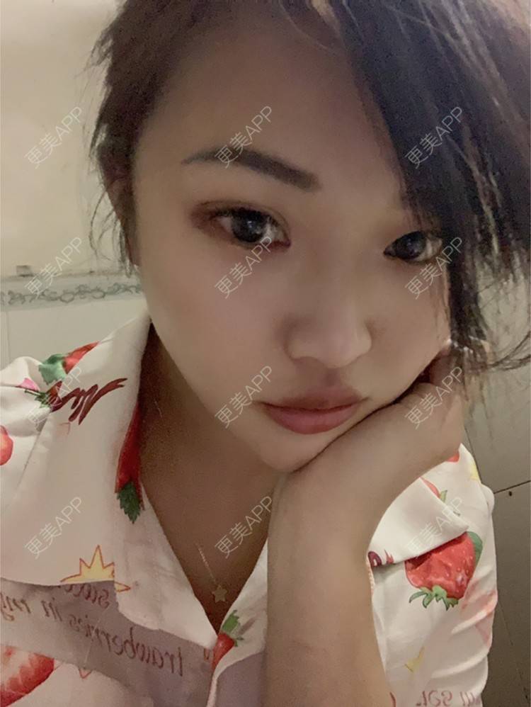 更美 - 虽醉尤醒的激光洗眉经验 | 上海 | 激光洗眉