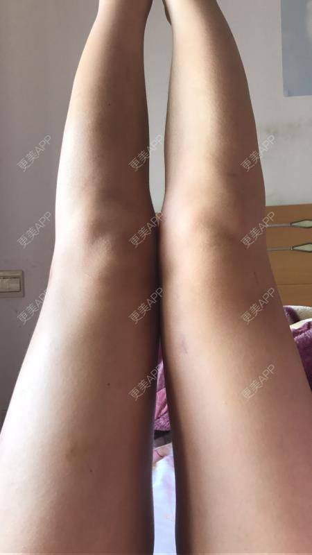 更美 - 更美用户P3NzNvpla1的冷冻溶脂经验 | 冷冻溶脂