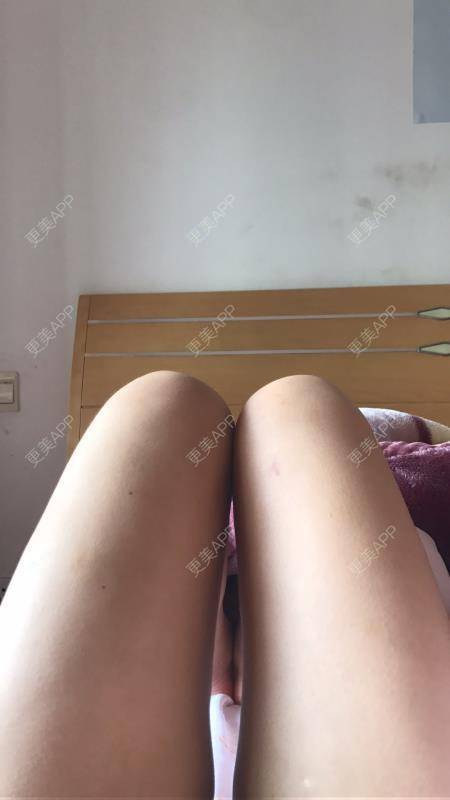 更美 - 更美用户P3NzNvpla1的冷冻溶脂经验 | 冷冻溶脂