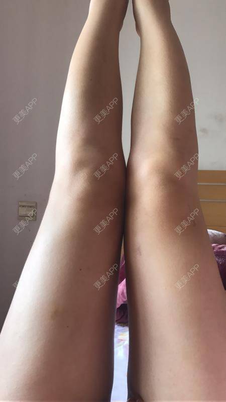 更美 - 更美用户P3NzNvpla1的冷冻溶脂经验 | 冷冻溶脂