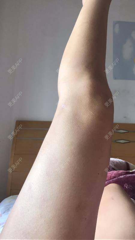 更美 - 更美用户P3NzNvpla1的冷冻溶脂经验 | 冷冻溶脂