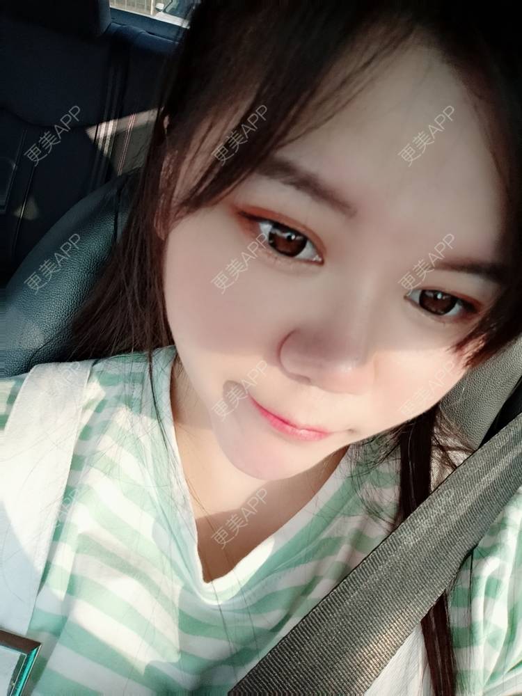 更美 - sonder.的下巴经验 | 下巴 | 硅胶垫下巴 | 长沙 | 视频日记