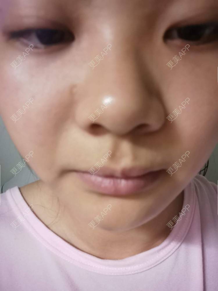 更美 - 不一“斑”的人的激光淡化红血丝经验 | 激光淡斑 | 祛斑祛色素 | 化学剥脱淡斑 | 皮秒激光 | 淡斑套餐