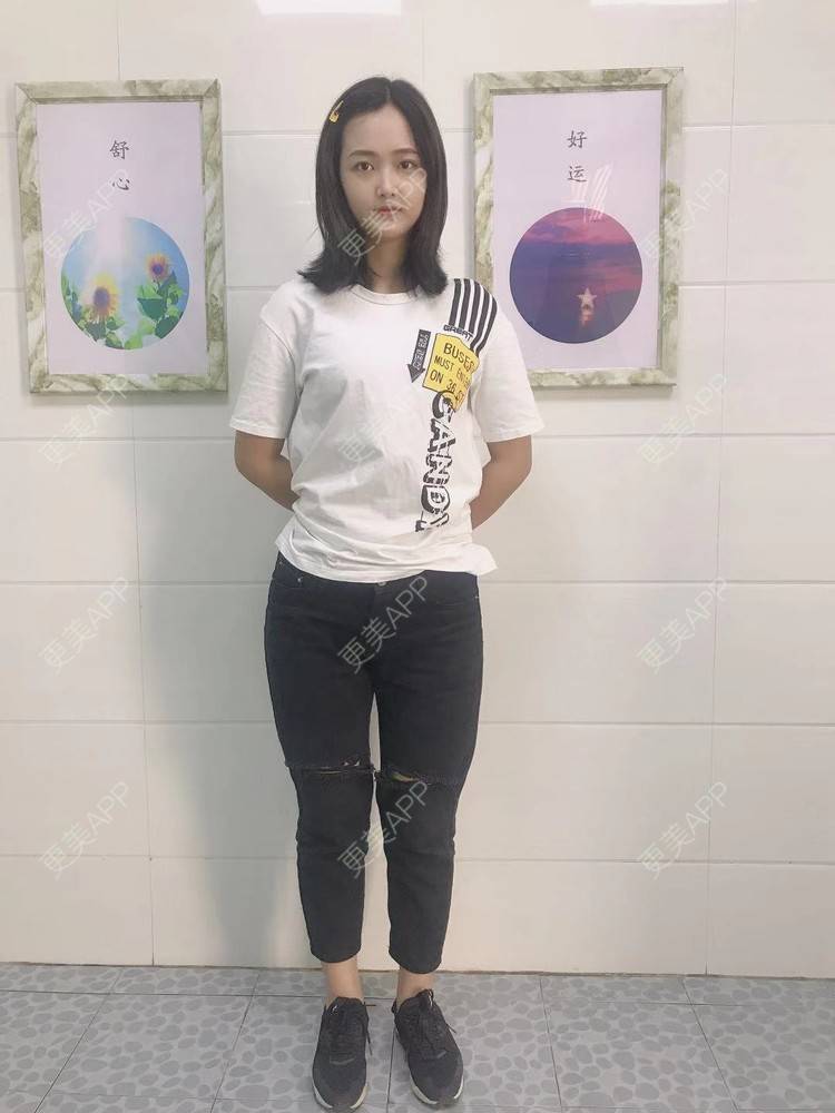 更美 - 七七琦琦琪琪的吸脂经验 | 吸脂 | 吸脂塑臀 | 武汉