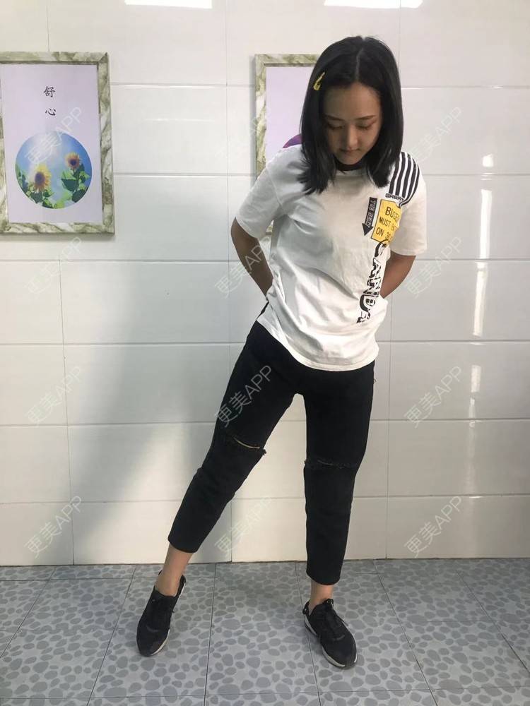 更美 - 七七琦琦琪琪的吸脂经验 | 吸脂 | 吸脂塑臀 | 武汉