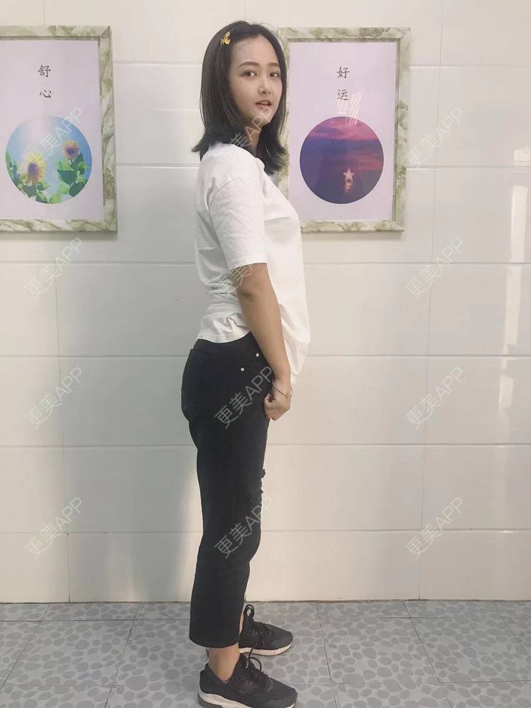 更美 - 七七琦琦琪琪的吸脂经验 | 吸脂 | 吸脂塑臀 | 武汉