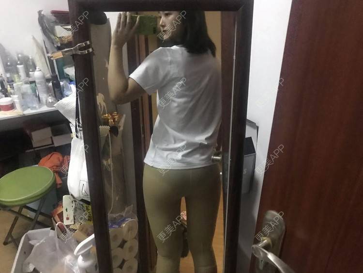 更美 - 七七琦琦琪琪的吸脂经验 | 吸脂 | 吸脂塑臀 | 武汉