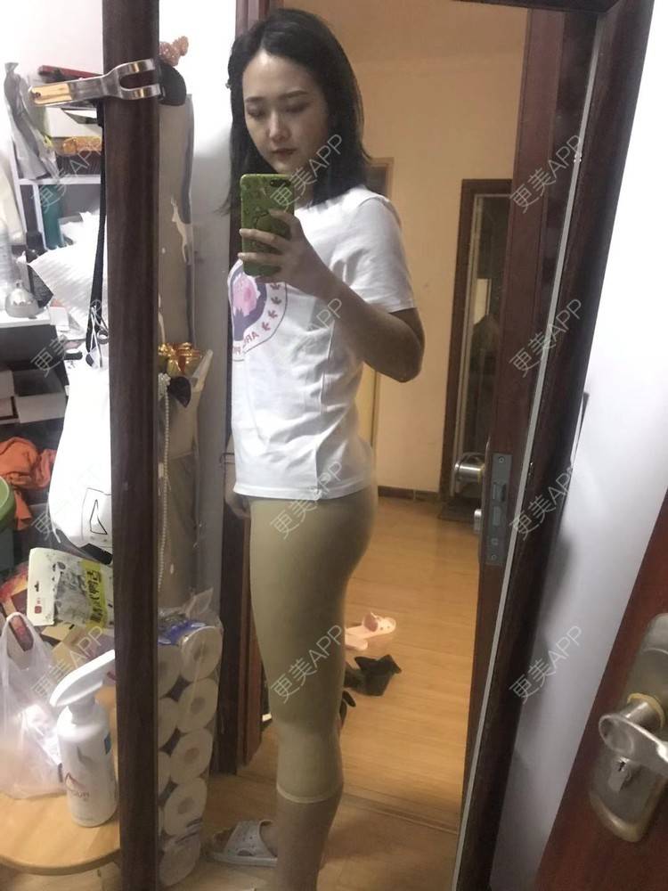 更美 - 七七琦琦琪琪的吸脂经验 | 吸脂 | 吸脂塑臀 | 武汉