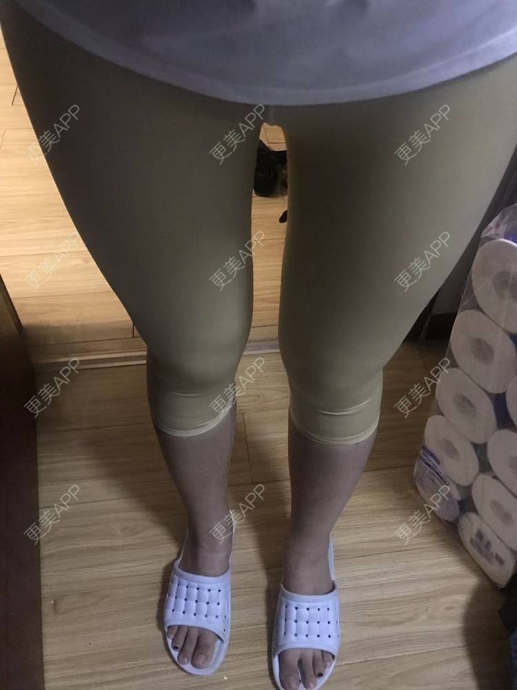 更美 - 七七琦琦琪琪的吸脂经验 | 吸脂 | 吸脂塑臀 | 武汉