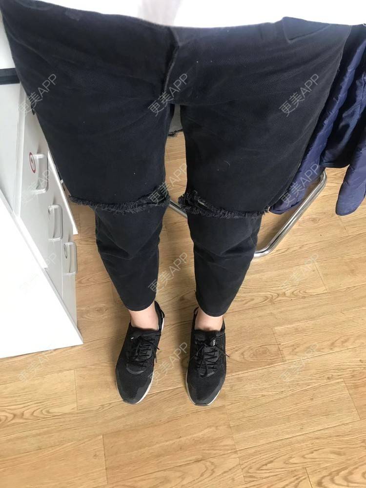 更美 - 七七琦琦琪琪的吸脂经验 | 吸脂 | 吸脂塑臀 | 武汉