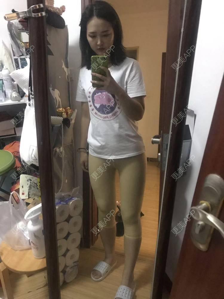 更美 - 七七琦琦琪琪的吸脂经验 | 吸脂 | 吸脂塑臀 | 武汉