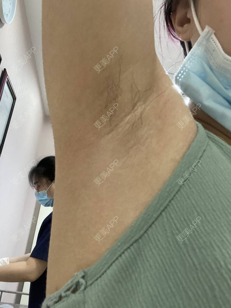 更美 - ruige的激光脱腋毛经验 | 激光脱毛 | 激光脱腋毛 | 北京