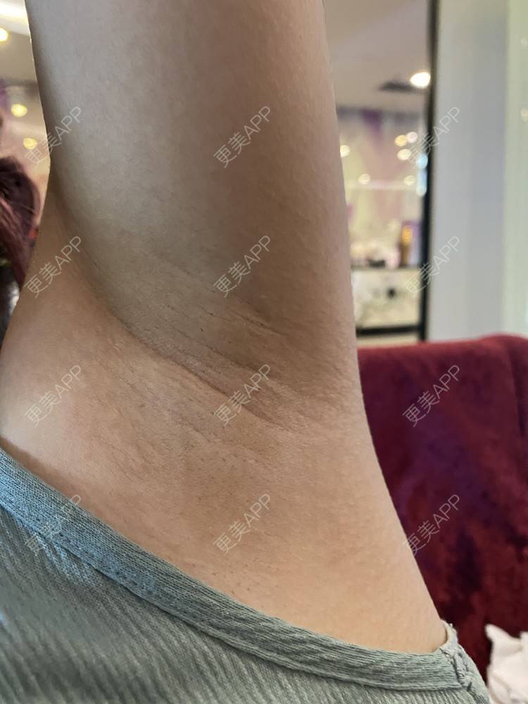 更美 - ruige的激光脱腋毛经验 | 激光脱毛 | 激光脱腋毛 | 北京