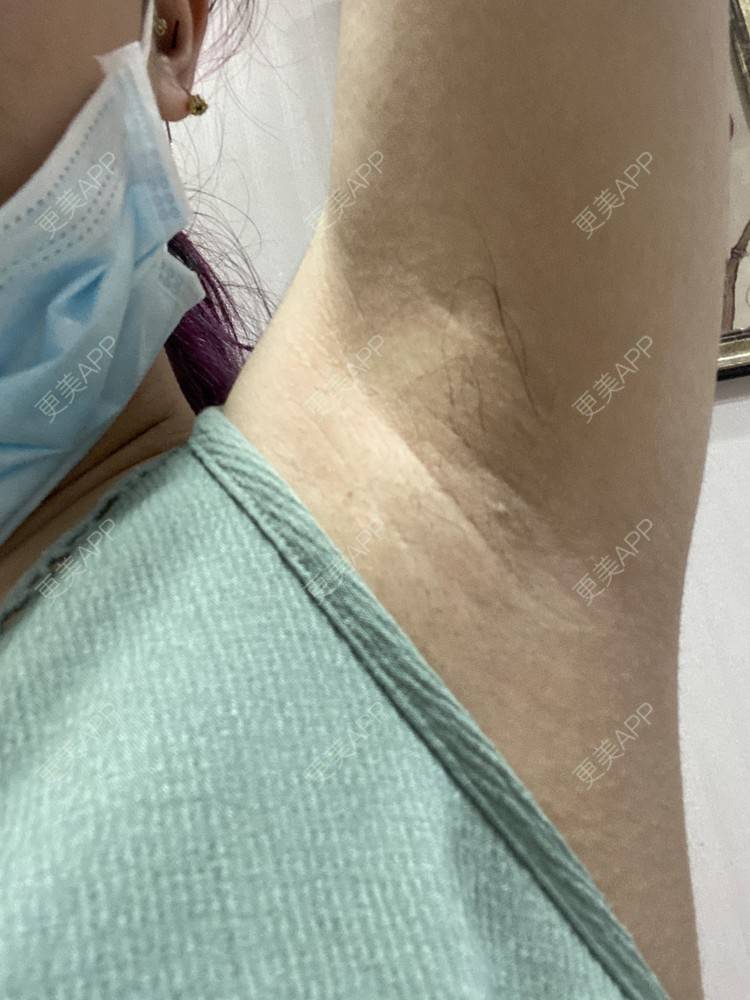 更美 - ruige的激光脱腋毛经验 | 激光脱毛 | 激光脱腋毛 | 北京