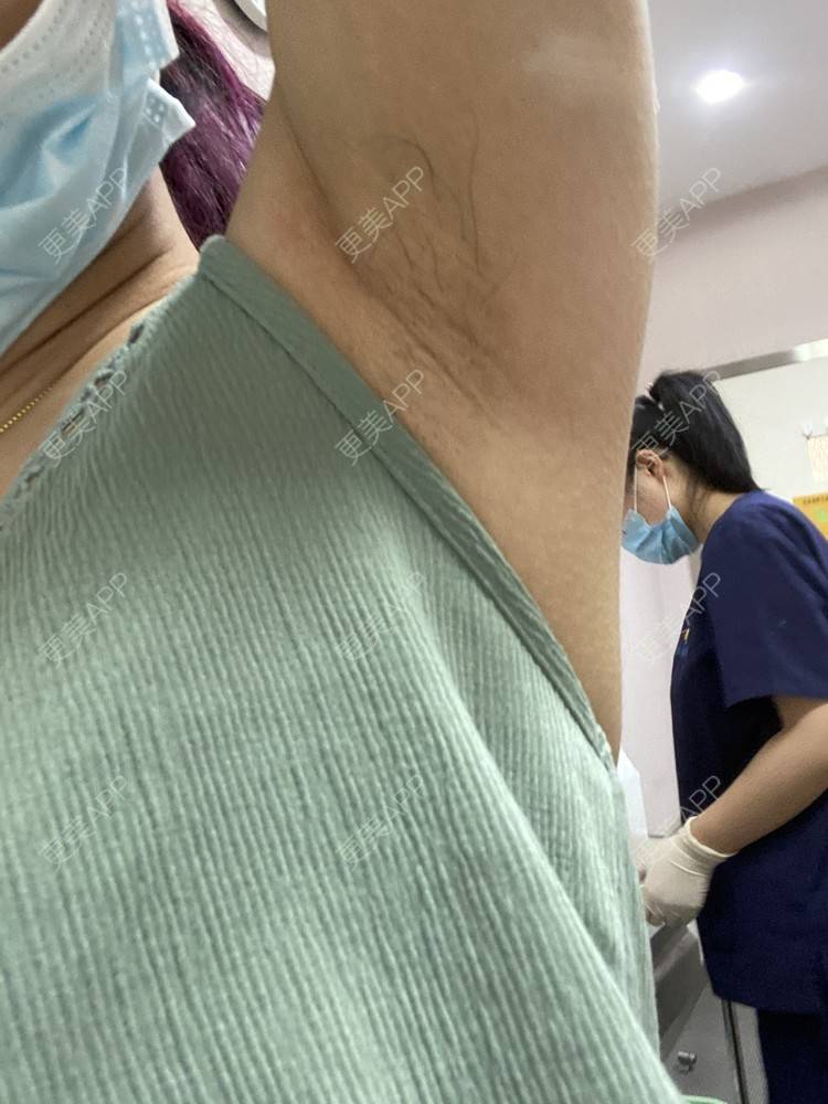 更美 - ruige的激光脱腋毛经验 | 激光脱毛 | 激光脱腋毛 | 北京