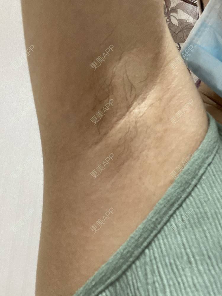 更美 - ruige的激光脱腋毛经验 | 激光脱毛 | 激光脱腋毛 | 北京