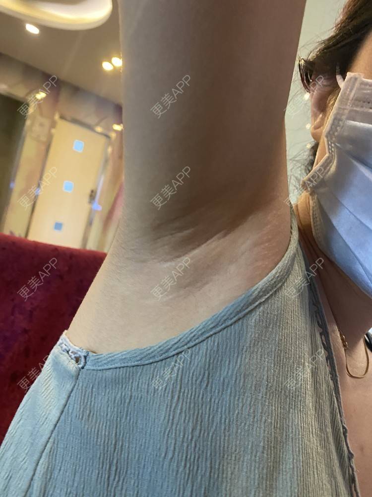 更美 - ruige的激光脱腋毛经验 | 激光脱毛 | 激光脱腋毛 | 北京