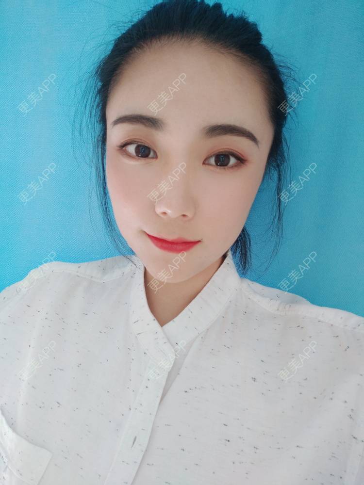 更美 - 更美魔女的埋线提升经验 | 埋线提升 | 郑州