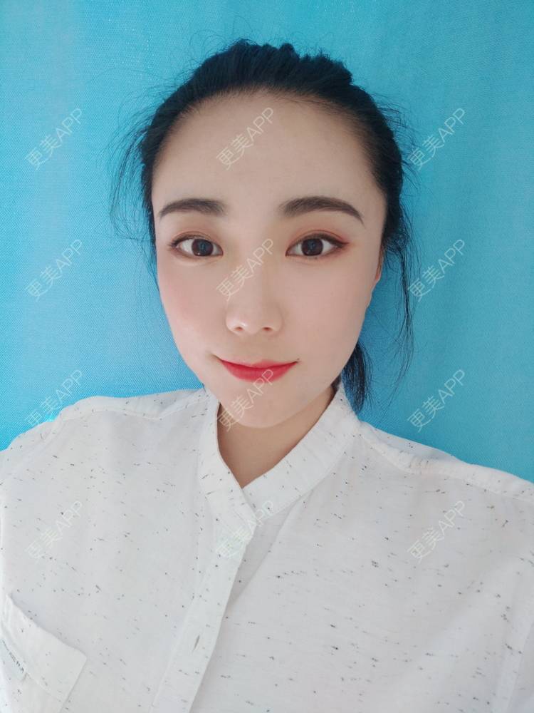 更美 - 更美魔女的埋线提升经验 | 埋线提升 | 郑州
