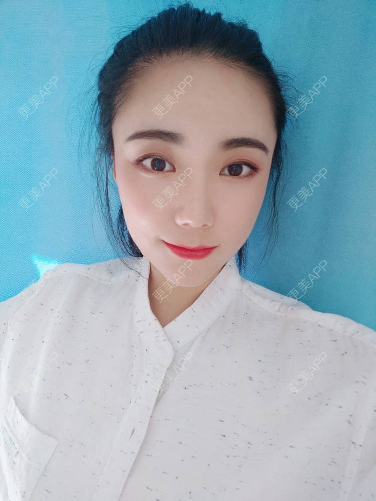 更美 - 更美魔女的埋线提升经验 | 埋线提升 | 郑州