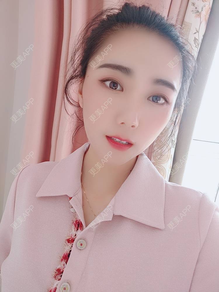 更美 - 更美魔女的埋线提升经验 | 埋线提升 | 郑州