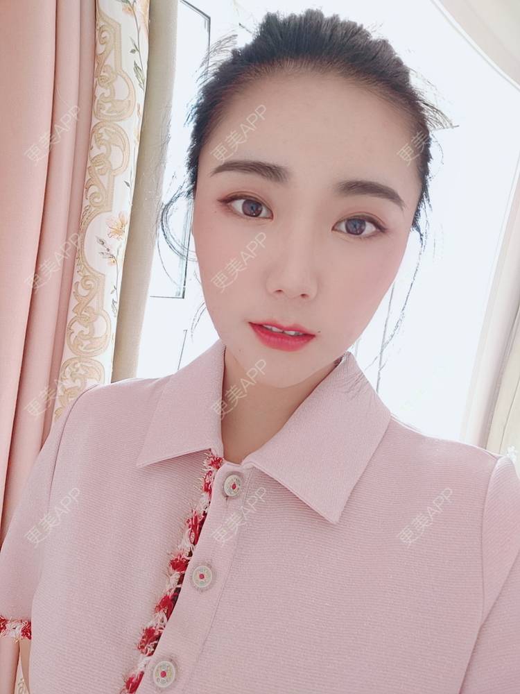 更美 - 更美魔女的埋线提升经验 | 埋线提升 | 郑州