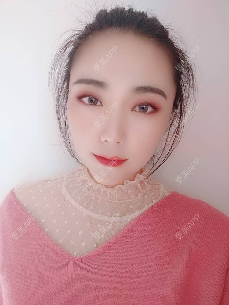 更美 - 更美魔女的埋线提升经验 | 埋线提升 | 郑州