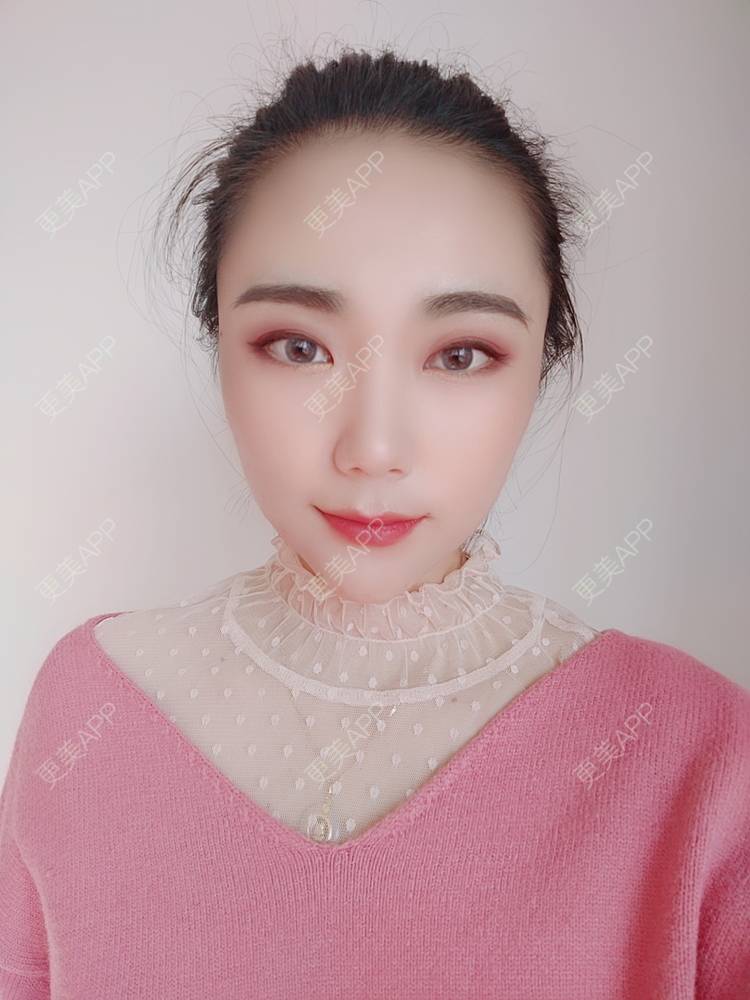 更美 - 更美魔女的埋线提升经验 | 埋线提升 | 郑州
