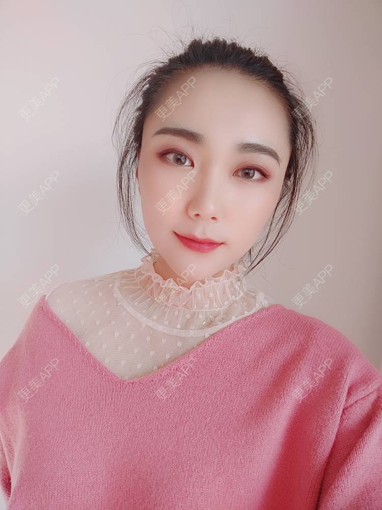更美 - 更美魔女的埋线提升经验 | 埋线提升 | 郑州