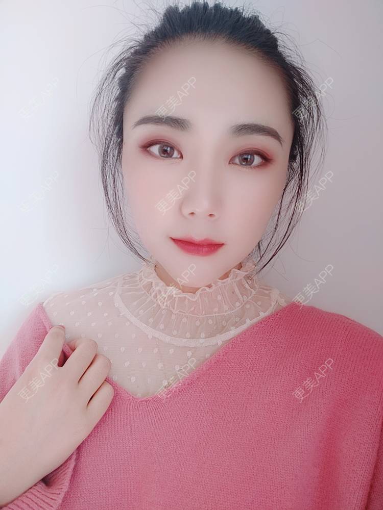 更美 - 更美魔女的埋线提升经验 | 埋线提升 | 郑州